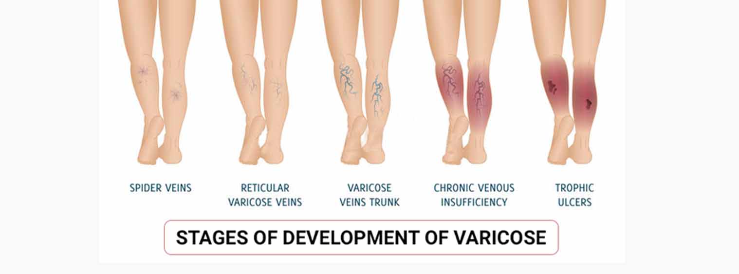 Understanding Varicose Veins